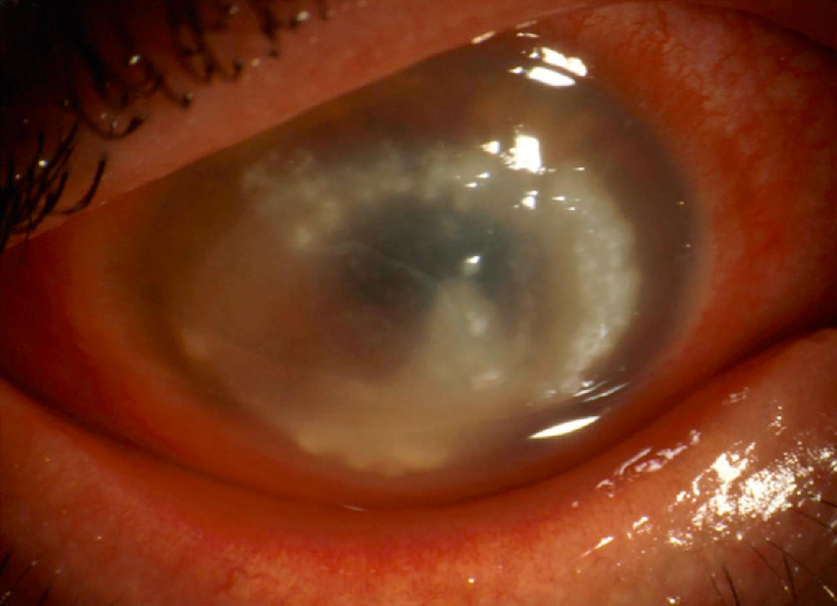 FIGURE 270.3, Ring infiltrate and severe scleritis in advanced Acanthamoeba keratitis.