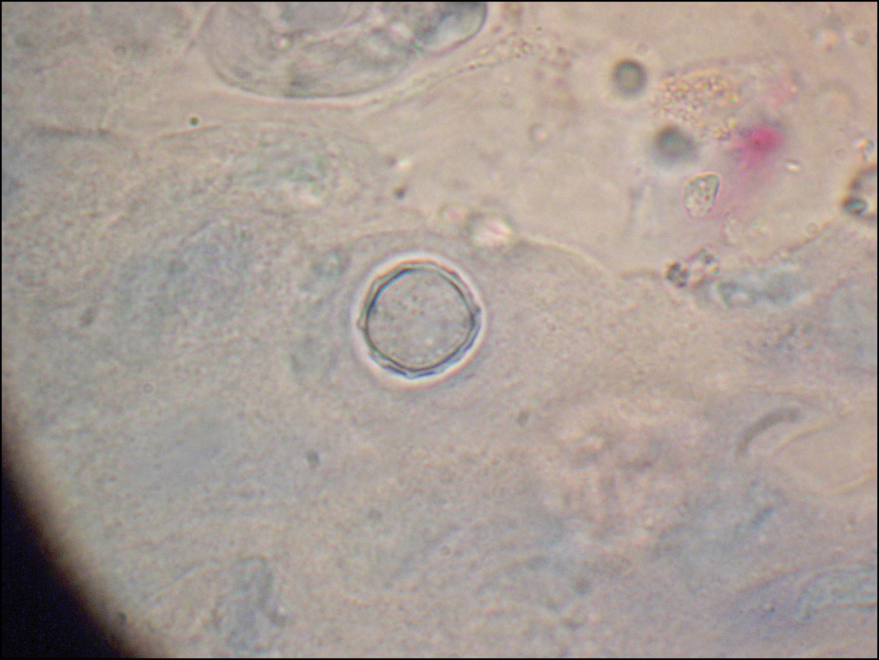 Fig. 82.2, Acanthamoeba cyst from a superficial corneal scraping. (Diff-Quik Stain, original magnification 100×.)