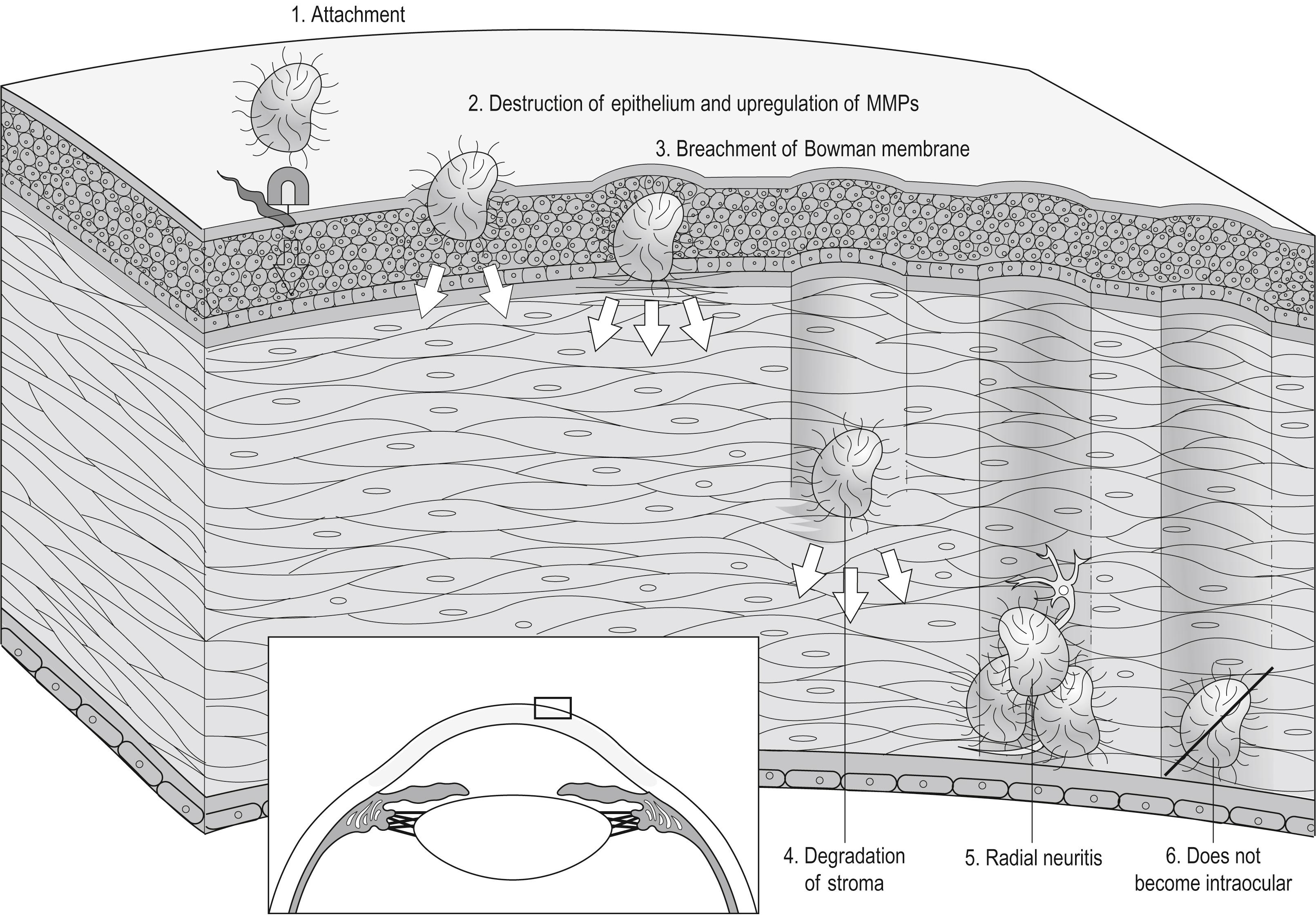 Fig. 82.3, Proposed pathogenesis of acanthamoebal corneal infection. MMPs, Matrix metalloproteinases.