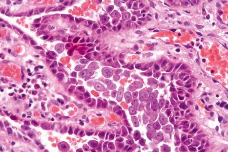 Fig. 5.1, Acantholysis: the keratinocytes are rounded and separated from each other to form an intraepidermal blister. Villi formed from the underlying dermal papillae typically project into suprabasal cavities.