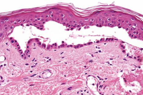 Fig. 5.12, Pemphigus vulgaris: cell-free example showing a linear palisade of intact basal keratinocytes – the so-called ‘tombstone’ appearance.