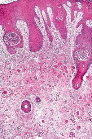 Fig. 5.18, Pemphigus vegetans: follicular involvement is seen on the right.