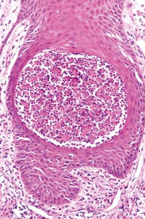 Fig. 5.19, Pemphigus vegetans: there are numerous eosinophils. Note the acantholysis.