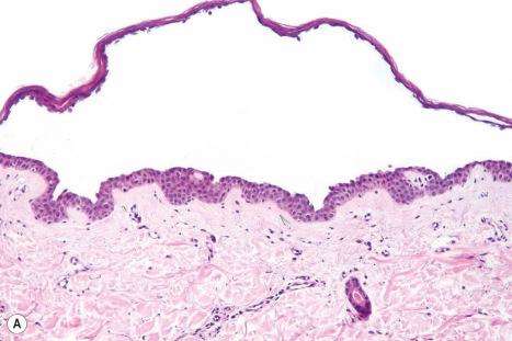 Fig. 5.25, Pemphigus foliaceus: ( A ) in this example, there is a cell-free, subcorneal blister; ( B ) occasional acantholytic cells are present adjacent to the roof.