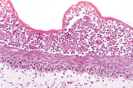 Fig. 5.27, Pemphigus foliaceus: in this example, the blister cavity contains numerous neutrophils. Acantholytic cells are conspicuous.