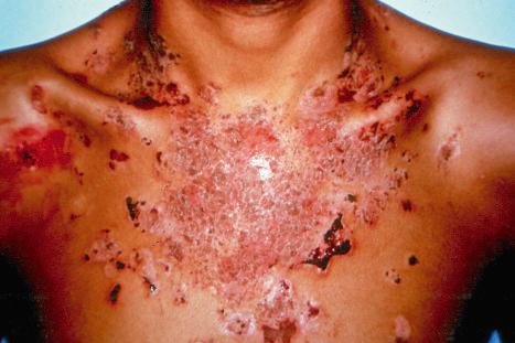 Fig. 5.34, Paraneoplastic pemphigus: there are numerous erosions and crusted lesions.