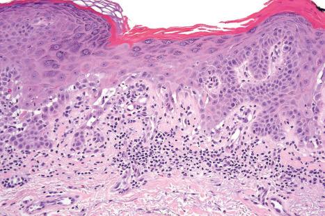 Fig. 5.36, Paraneoplastic pemphigus: this medium-power view shows suprabasal acantholysis and interface change. Note the hyperkeratosis and hypergranulosis.