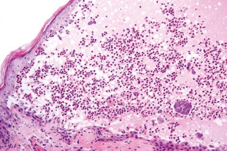 Fig. 5.41, IgA pemphigus: this biopsy is from the edge of an established blister. Note the heavy inflammatory cell infiltrate and focal acantholysis.