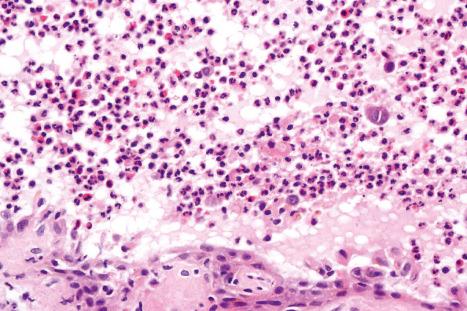 Fig. 5.42, IgA pemphigus: the blister cavity contains neutrophils and eosinophils.