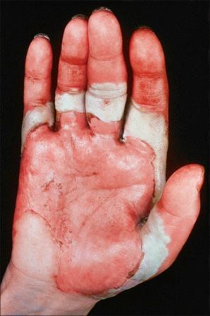 Fig. 5.7, Pemphigus vulgaris: extensive trauma-induced blisters.