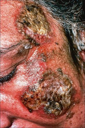 Fig. 5.8, Pemphigus vulgaris: extensive disease can be very disfiguring.