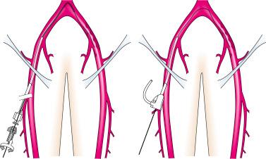 Fig. 31.1, Retrograde femoral access for a contralateral approach.