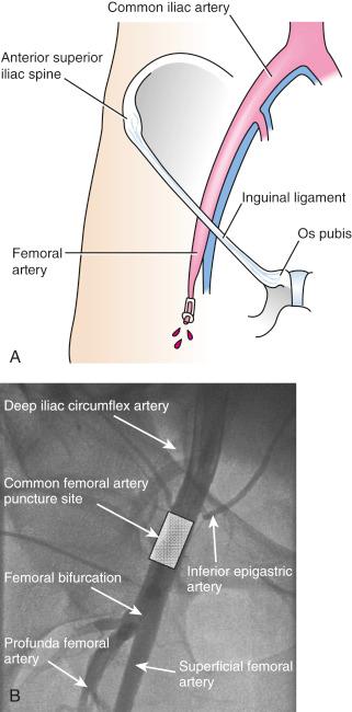 Fig. 31.2, Accessing the femoral artery.