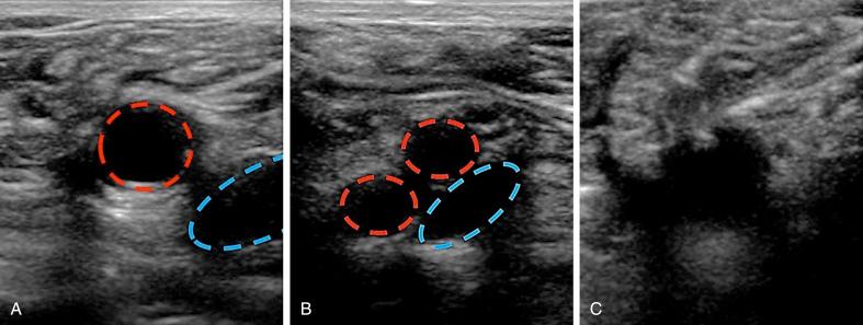 Fig. 31.4, (A) Ultrasound visualization of common femoral artery (red circle) and its relationship with femoral vein (blue semicircle) . (B) Ultrasound visualization of femoral artery bifurcation into superficial and profunda (red circles) and its relationship with femoral vein (blue circle) . (C) Ultrasound visualization of needle tip entering at the anterior wall of the common femoral artery.