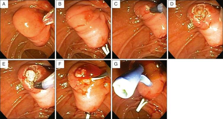 A, Large native papilla; B, pancreatic stent in place; C, fistulotomy with mucosal incision; D, biliary orifice; E, prolapsing papillary neoplasm; F, cannulation with wire; G, biliary and pancreatic stents in place.