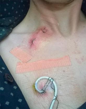 Fig. 5.3, Photograph of a patient with a tunnel infection. There is erythema along the course of the subcutaneous catheter and at the exit site.