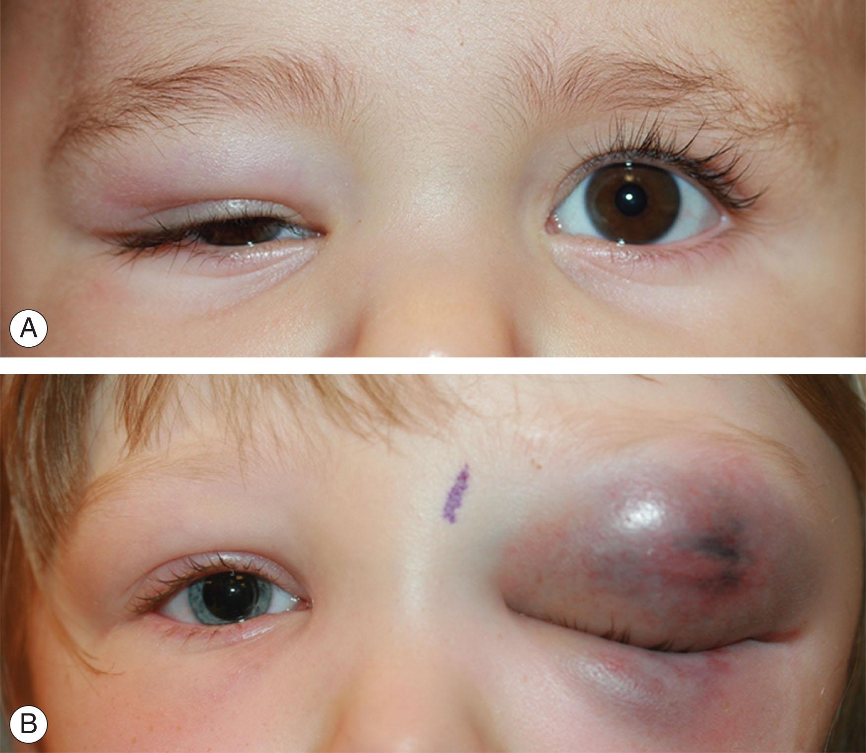 Fig. 70.2, Eyelid contusions. (A) A 9-month-old girl pulled herself to stand within her crib and subsequently fell, hitting the orbit. (B) A 4-year-old girl collided head-to-head on the playground with another child. A small ecchymosis rapidly increased to cause complete ptosis. Eyelid retractors were required to examine the eye, which remained normal except for a small subconjunctival hemorrhage temporally.