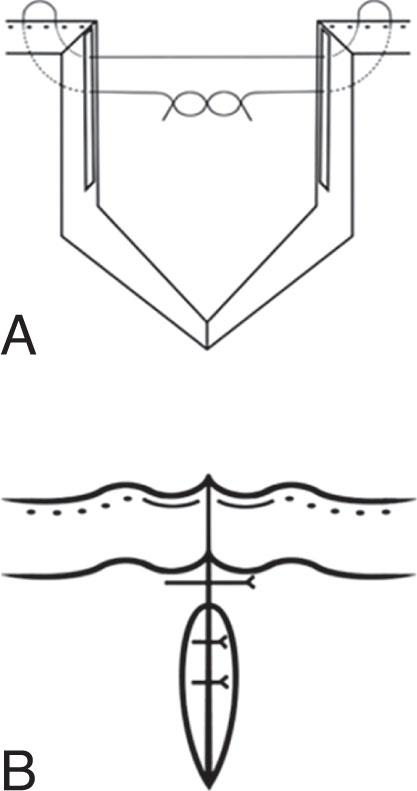 Fig. 70.4, Method for closure of a marginal eyelid laceration without lacrimal system involvement. (A) Approximation of the edges of the laceration is achieved with a vertical mattress suture placed within the tarsus using an absorbable 6-0 polyglactin 910 suture with the knot buried within the tissue. (B) Additional tarsal and superficial interrupted sutures may be placed in addition to repair the marginal eyelid laceration completely.