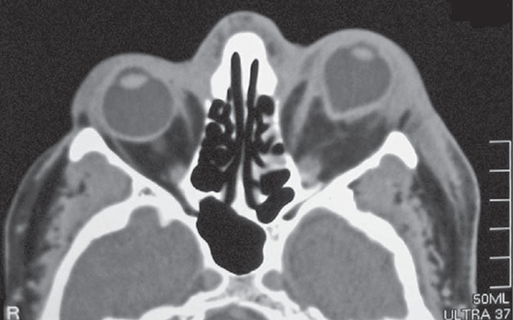 Fig. 70.6, Posterior globe tenting is shown in a case of orbital compartment syndrome associated with edema within the left orbit (arrow).