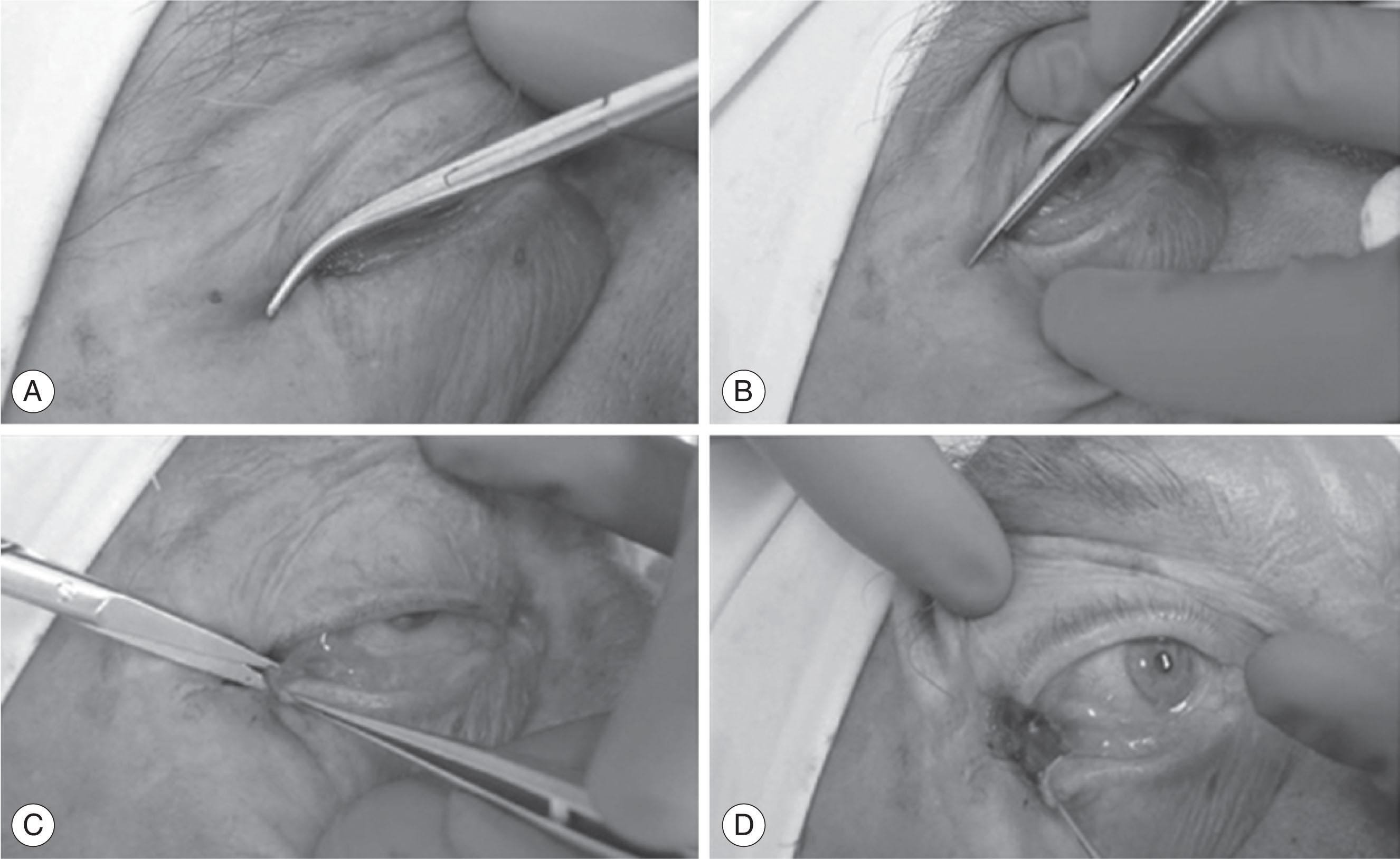 Fig. 70.7, Technique of lateral canthotomy and cantholysis for orbital compartment syndrome. (A) A clamp is placed on the skin of the lateral canthus to achieve hemostasis. (B) Lateral canthal skin is incised to the orbital rim. (C) Lower eyelid is retracted inferiorly exposing the tissue between the anterior and posterior lamellae of the lower eyelid and the lateral orbital rim. A closed scissor is inserted into this space and strummed back-and-forth to identify the inferior lateral canthal tendon, which once located is incised. (D) After cutting the lateral canthal tendon, the temporal aspect of the lower eyelid will evert easily and a drop in the orbital pressure should be palpable.