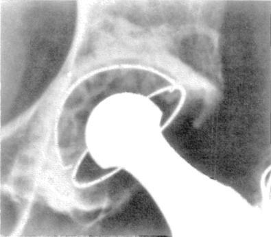 Fig. 7.1, A radiograph taken 5 years after total hip arthroplasty shows the appearance of the bone-cement interface around an acetabular component that was inserted using modern cementing techniques.