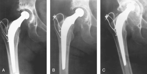 Fig. 7.2, Radiographs of a 58-year-old man with osteoarthritis of the right hip taken 1 year postoperatively (A), 10 years later (B), and 22 years later (C). (A) shows radiolucency of 1 mm in Gruen zone 1.