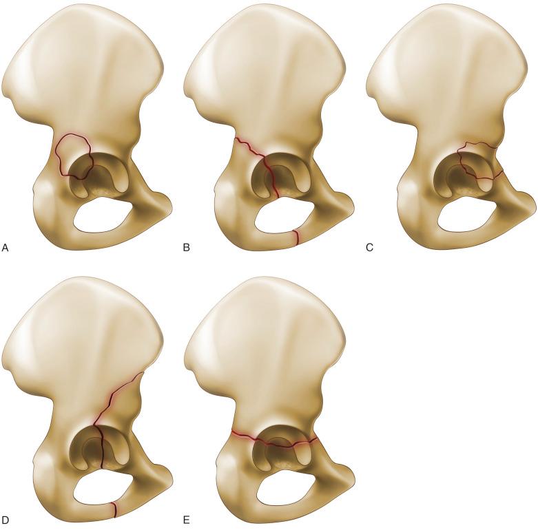 Fig. 46.2, Elementary fracture patterns according to Letournel and Judet. (A) Posterior wall. (B) Posterior column. (C) Anterior wall. (D) Anterior column. (E) Transverse.