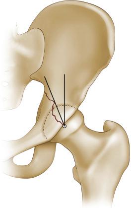 Fig. 46.4, Anteroposterior roof arc measurement.