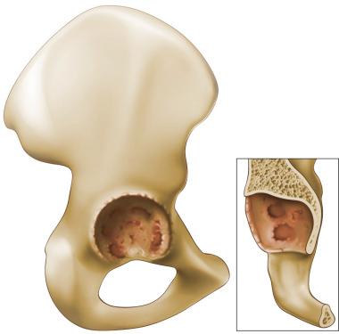 Fig. 92.1, Paprosky type I acetabular defect. The rim is intact and the columns are fully supportive of a hemispheric component. Only localized bone lysis is noted.