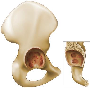 Fig. 92.2, Paprosky type IIA acetabular defect. The rim remains intact; however, it is enlarged superiorly to create an oval.