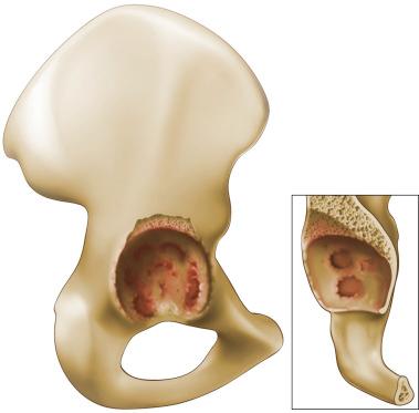 Fig. 92.3, Paprosky type IIB acetabular defect. The superior rim is absent; however, the column remains fully supportive.