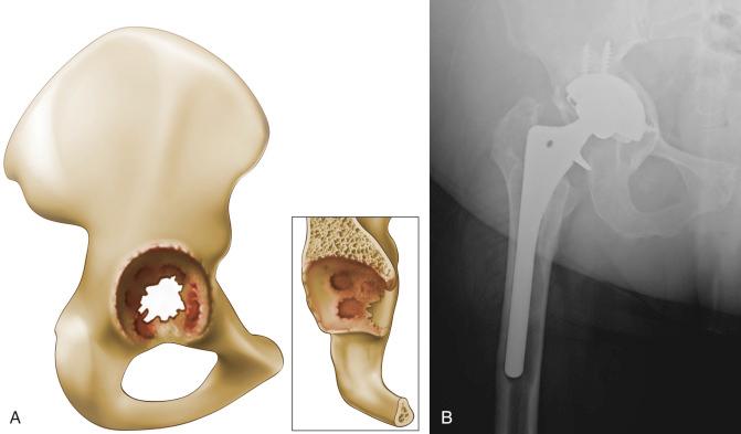 Fig. 92.4, (A) Paprosky type IIC acetabular defect. The rim is enlarged and the medial wall is destroyed. The teardrop may be obliterated as well. (B) Radiograph demonstrating a Paprosky type IIC acetabular defect. The teardrop is obliterated and the component has migrated medially past the Köhler line.