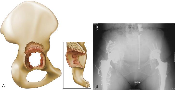 Fig. 92.5, (A) Paprosky type IIIA acetabular defect. Bone loss along the superior rim and dome of the acetabulum. The medial teardrop is still present. (B) The right hip demonstrates a Paprosky type IIIA defect with superolateral migration of the acetabular component. The acetabular component has eroded superiorly and shifted to a vertical position. The left hip demonstrates placement of the acetabular component with a high hip center.