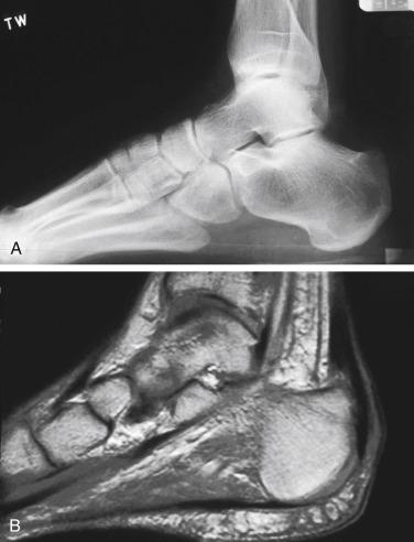 Fig. 9.1, (A) Lateral radiograph of calcaneus demonstrating Haglund’s deformity. (B) Sagittal magnetic resonance imaging of the same patient showing changes at Achilles tendon from bony prominence and its effect on Achilles tendon, with thickening and fibrosis as it passes by the bone and more proximally.