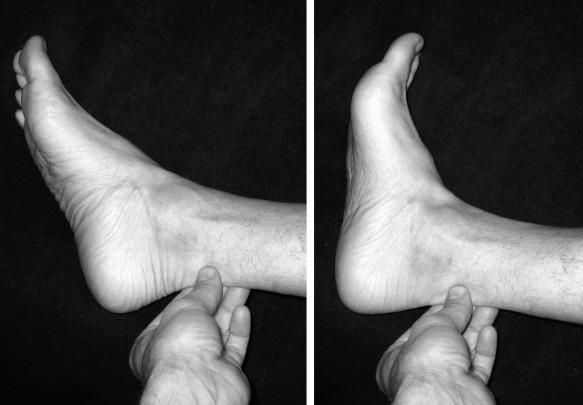 Fig. 9.2, Tenderness with squeezing the Achilles and crepitance with range of motion are hallmarks of peritendinitis. The discomfort related to peritendinitis will be constant in location as the ankle is brought through a range of motion. With Achilles tendinosis, the tenderness moves with the thickened tendon during range of motion.