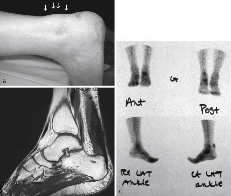 Fig. 9.3, (A) Noninsertional Achilles tendinopathy with characteristic swelling 2 to 5 cm above dorsal aspect of calcaneus. (B) Magnetic resonance imaging shows thickened Achilles tendon. A Haglund’s deformity also is noted. (C) Technetium bone scan demonstrating increased uptake in the Achilles tendon; the third phase of the scan, indicative of advanced intrasubstance degeneration.