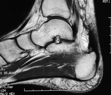Fig. 9.6, Magnetic resonance imaging demonstrates Haglund’s deformity with enlarged posterior superior aspect of the calcaneus.