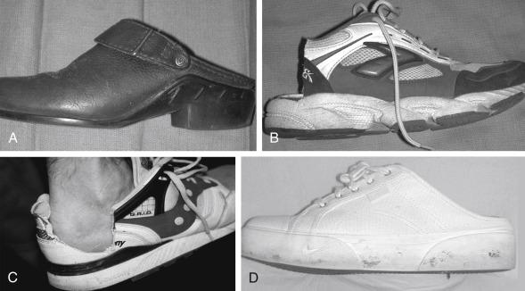 Fig. 9.7, Shoe Alternatives and Modifications for Patients with Achilles Tendinopathy.
