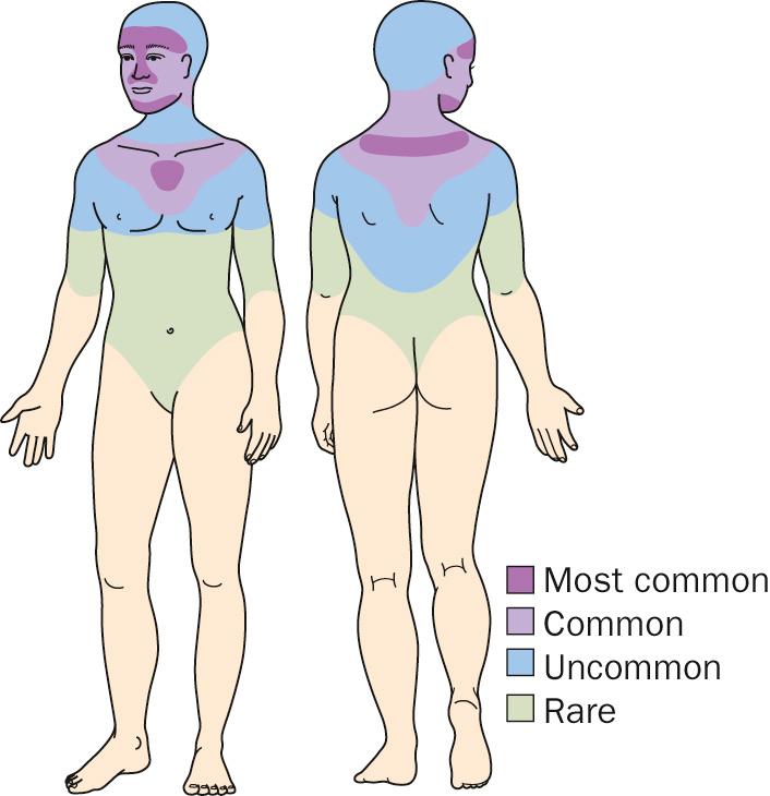 Fig. 4.1, Acne distribution diagram.