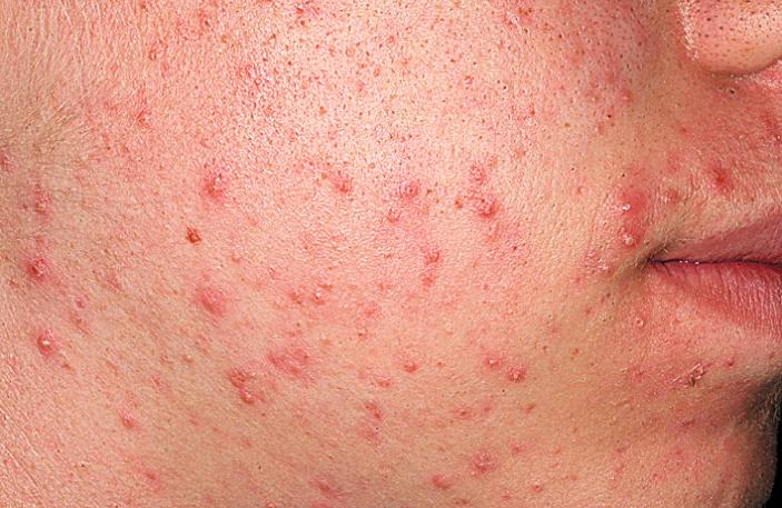 Fig. 4.11, Acne vulgaris. Moderate inflammatory and cystic acne vulgaris.