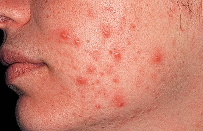 Fig. 4.12, Acne vulgaris. Moderate inflammatory and cystic acne vulgaris.