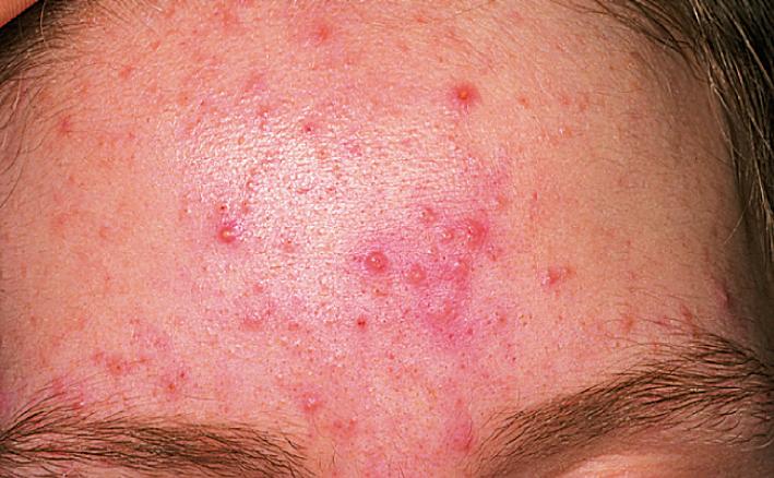 Fig. 4.13, Acne vulgaris typically starts on the central forehead, nose, and chin ( T distribution).