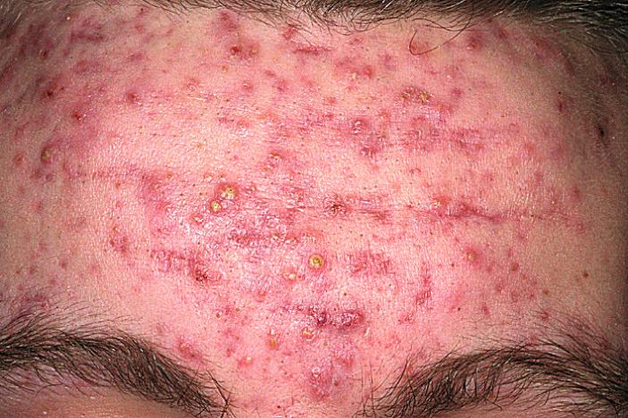 Fig. 4.14, Acne vulgaris. Severe inflammatory and cystic acne vulgaris on the forehead.