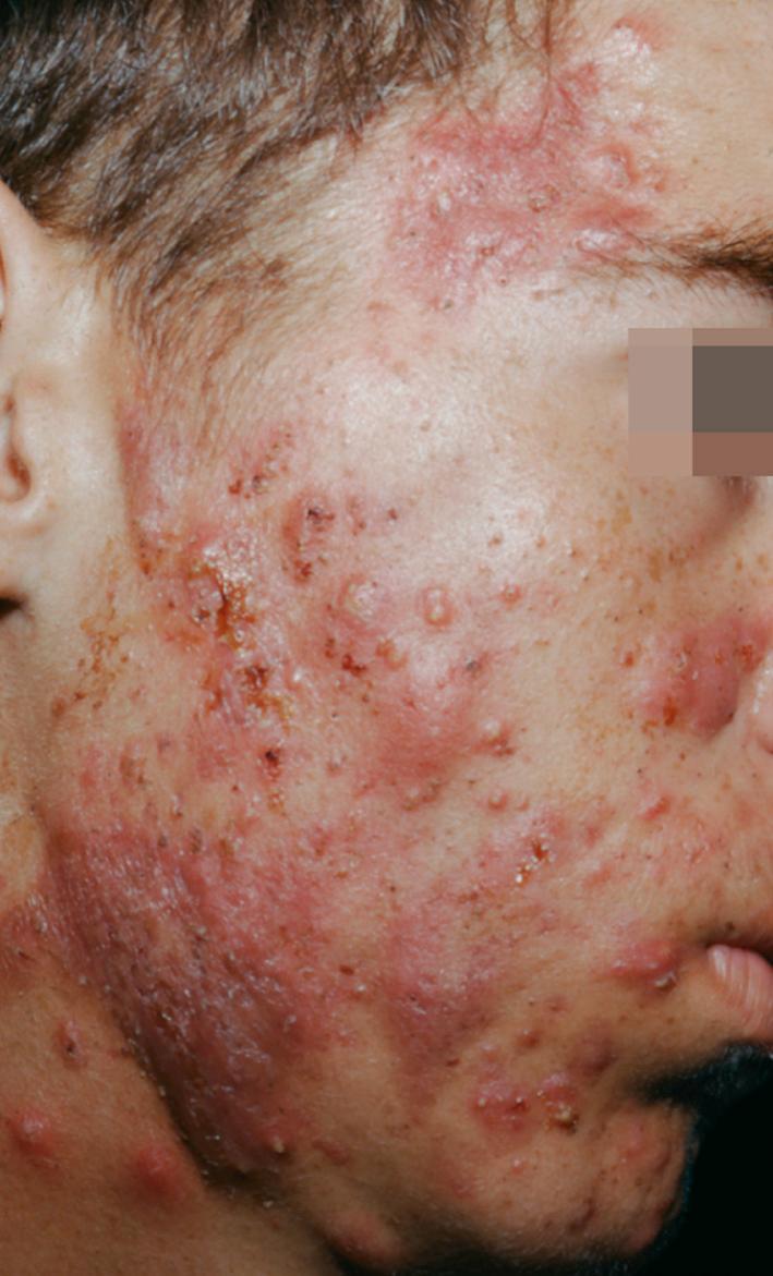 Fig. 4.15, Severe inflammatory acne vulgaris may be associated with fever and joint pain.