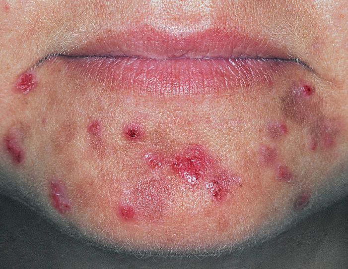 Fig. 4.16, Acne excoriée is produced from picking acne lesions and may result in delayed healing and scarring.