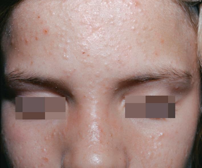 Fig. 4.3, Acne. Multiple closed comedones on the forehead. Moderate to severe acne responds slowly to treatment. Tazarotene may be used in combination with manual extraction.