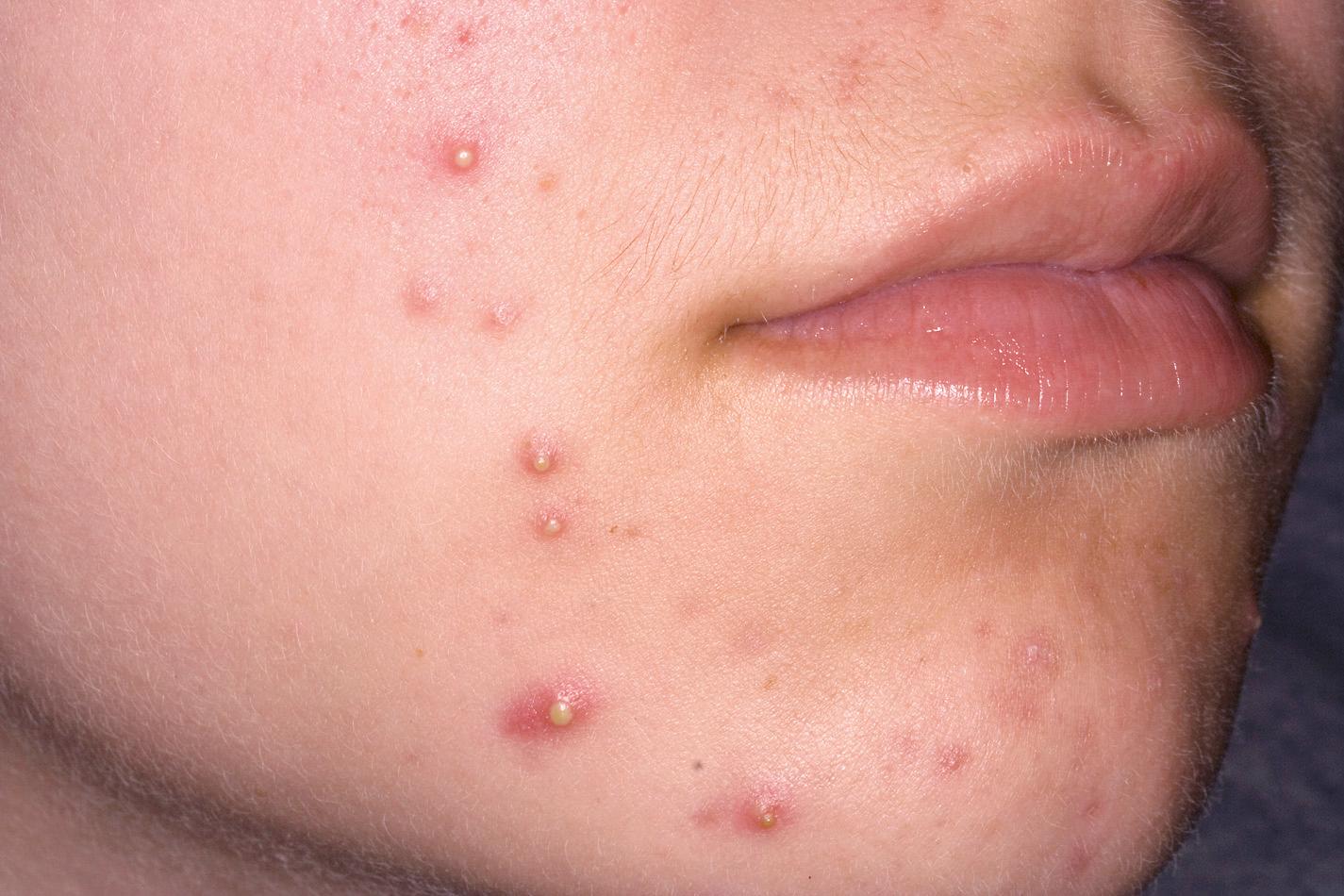 Fig. 4.4, Mild inflammatory acne. Mild acne with papules, pustules, and comedones.