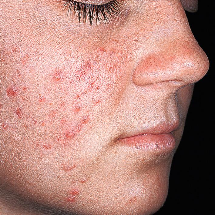 Fig. 4.5, Acne vulgaris. Papules and pustules seen in moderate inflammatory acne vulgaris.