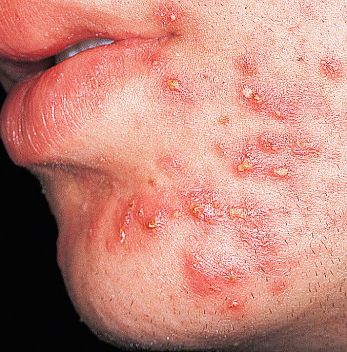 Fig. 4.6, Acne. Multiple pustules and cysts in exuberant inflammatory acne.