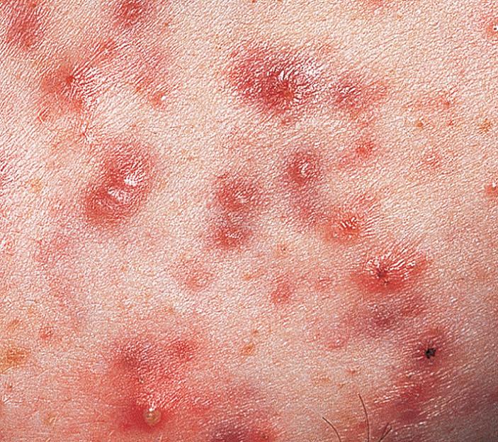 Fig. 4.7, Acne vulgaris. Multiple pustules and cysts in inflammatory acne vulgaris.